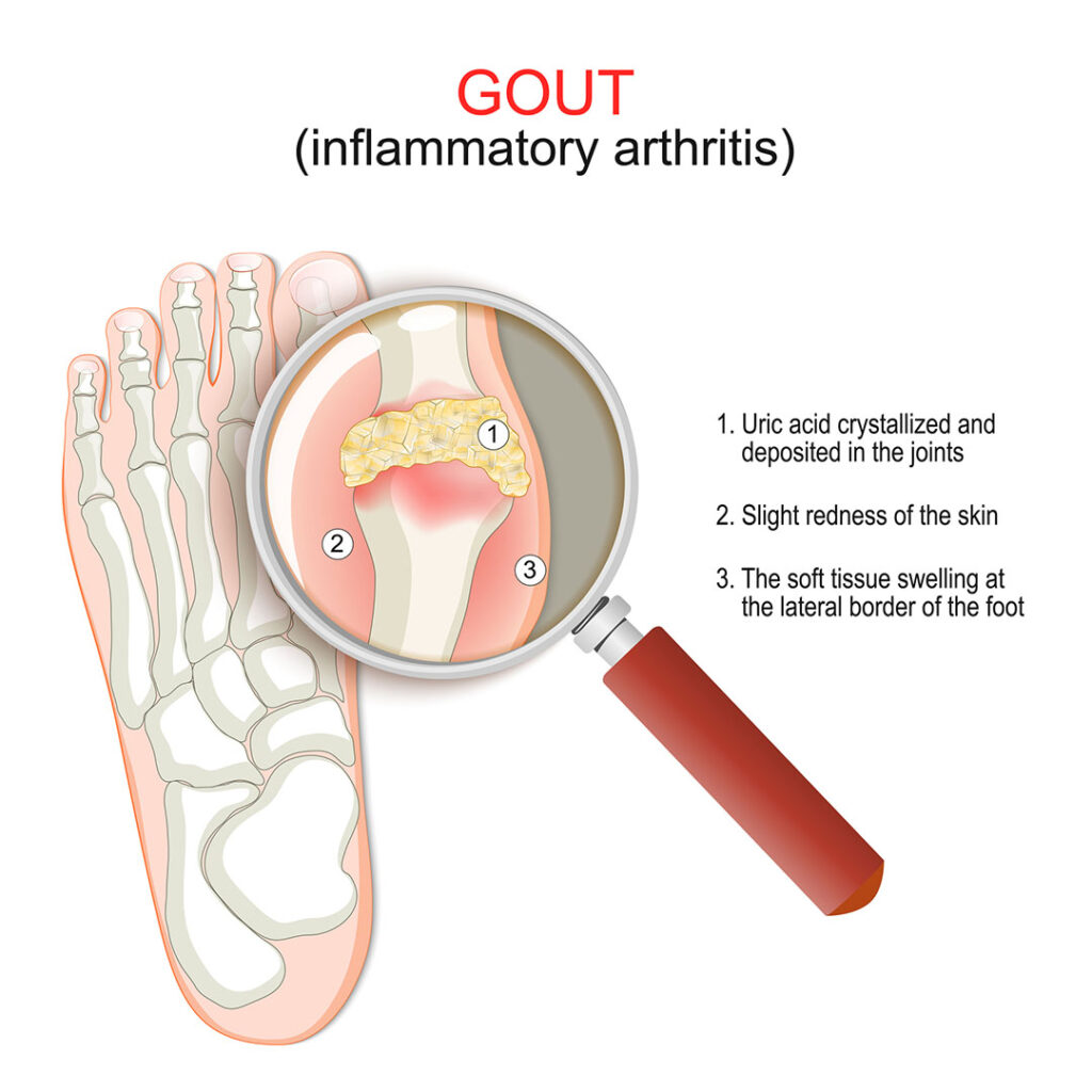Graphic showing a joint in a foot and symptoms of inflammatory arthritis